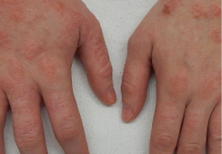 Dermatitis and eczema