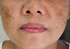 Melasma