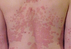 Psoriasis