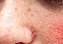 Rosacea