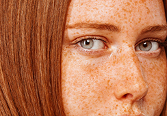 Freckles