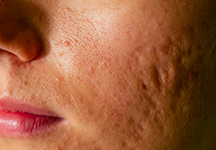 Post Inflammatory Hyperpigmentation